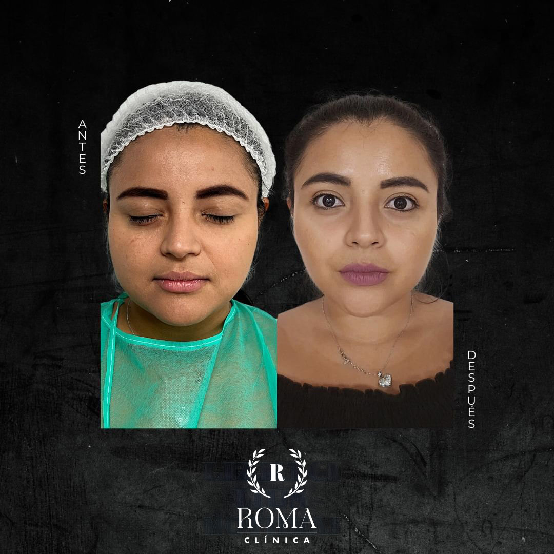 Imagen procedimiento bichectomia antes y después