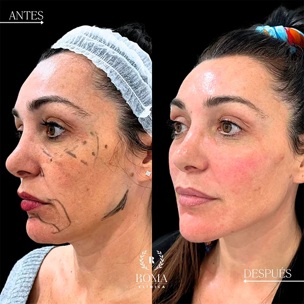 Tratamiento facial ideal para reducir arrugas, mejorar la luminosidad y revitalizar la piel en Málaga, medicina estetica facial