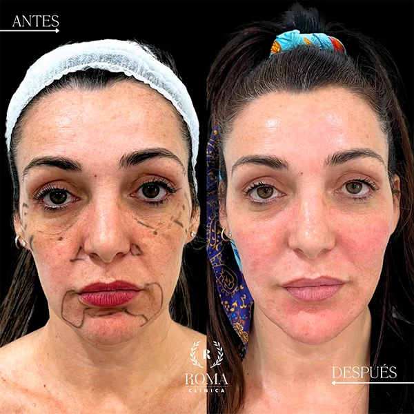 Paciente satisfecha tras recibir tratamiento facial en Clínica Roma, con resultados visibles de frescura y vitalidad en el rostro, en la mejor clinica estetica Malaga