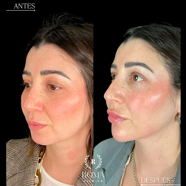 Profesional de estética realizando sesión facial rejuvenecedora en Clínica Roma, con atención cuidadosa y personalizada.