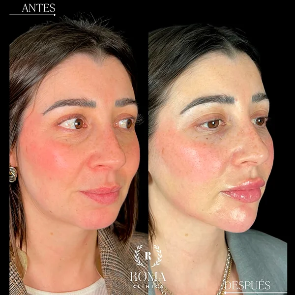 Imagen con zonas del rostro que se benefician del tratamiento facial antiedad en nuestra clinica estetica en Málaga.