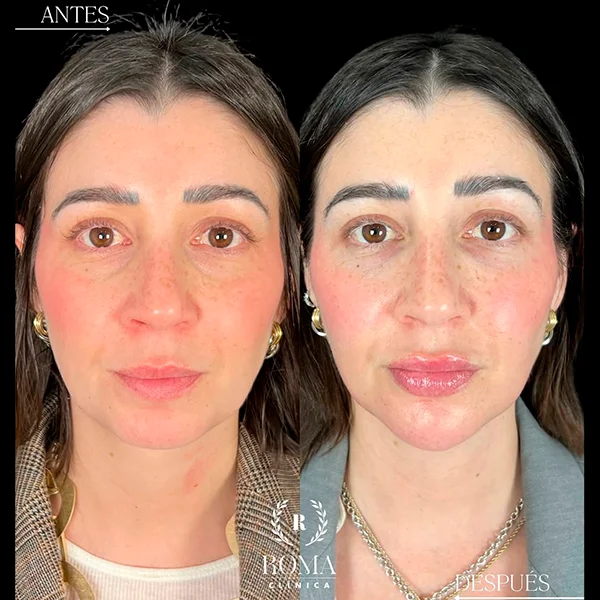 Resultado visible de un rostro más uniforme, hidratado y radiante gracias al tratamiento facial de Clínica Roma en Malaga.