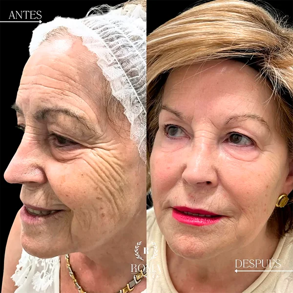 Aplicación de tecnología estética de última generación para rejuvenecer el rostro en Clínica Roma, centro estetico en Malaga.