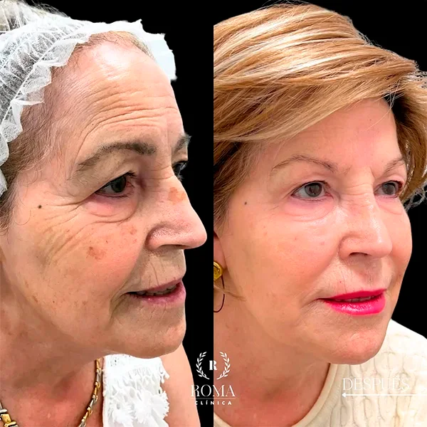 Resultado real del tratamiento facial con efecto natural en la piel, realizado en Clínica Roma, especialistas en estetica facial en Malaga.