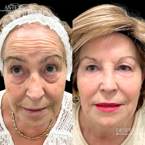 Asesoramiento personalizado en Clínica Roma para seleccionar el mejor tratamiento de rejuvenecimiento facial según cada tipo de piel, en la mejor clinica estetica Malaga