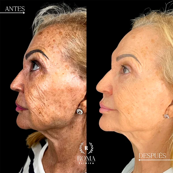Paciente disfrutando de una sesión cómoda y efectiva de rejuvenecimiento facial en Malaga, antes y despues, medicina estetica facial