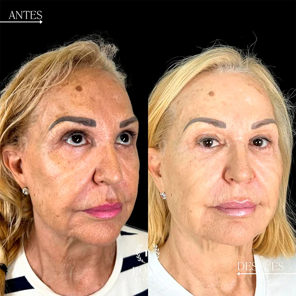 Primer plano que muestra la mejora en la luminosidad y elasticidad de la piel después del procedimiento en Clínica Roma.