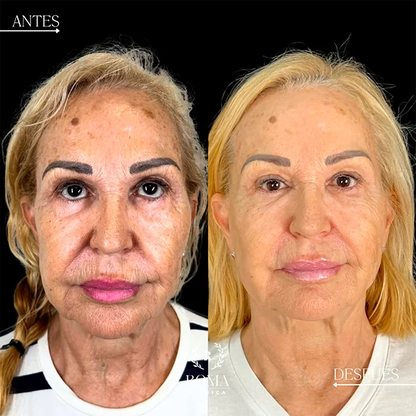 Comparativa visual que muestra la mejora en la textura y firmeza de la piel tras el tratamiento facial en Malaga, en la mejor clinica estetica