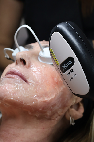 Resultado visible de una piel más tersa, firme y uniforme tras sesiones con Alma Harmony