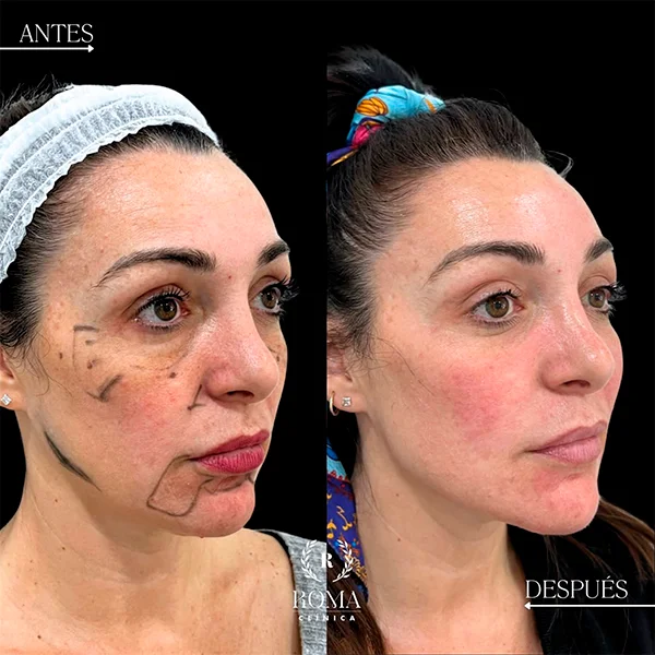 Procedimiento de rejuvenecimiento sin cirugía que mejora la textura y firmeza del rostro en nuestra clinica estetica de Malaga.