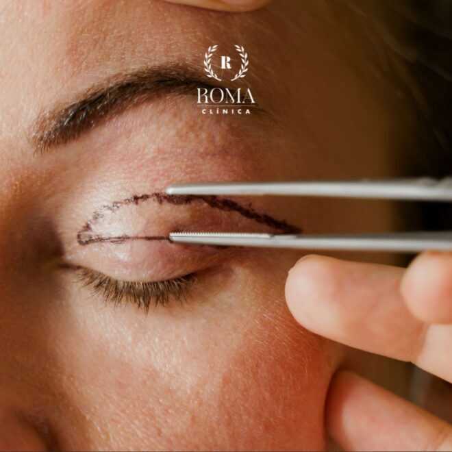 La mejor clinica de medicina estética en blefaroplastia