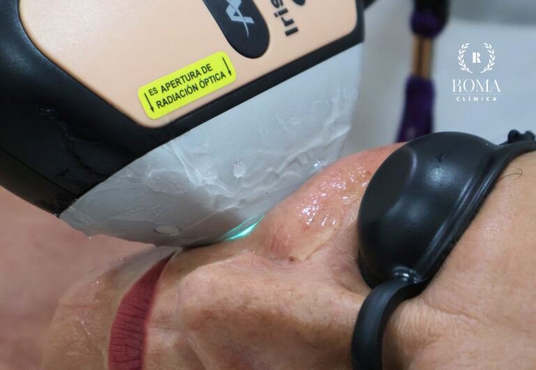 Luz pulsada en Málaga