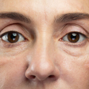 Mejor procedimiento para disminuir los signos de la edad en Málaga