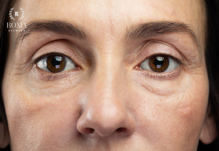 Mejor procedimiento para disminuir los signos de la edad en Málaga