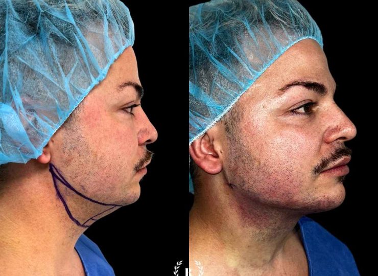 El mejor centro estético de Málaga imagen procedimiento lipopapada