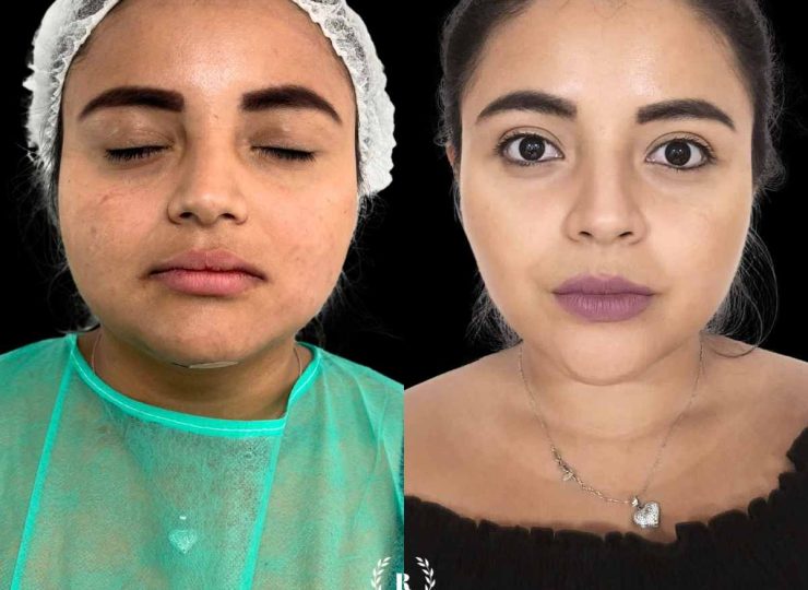 Imagen bichectomia en malaga, medicina estetica