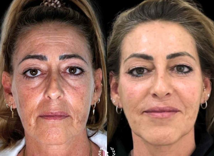 Imagen Rejuvenecimiento facial antes y después en Clinica Roma, la mejor clinica estetica Malaga