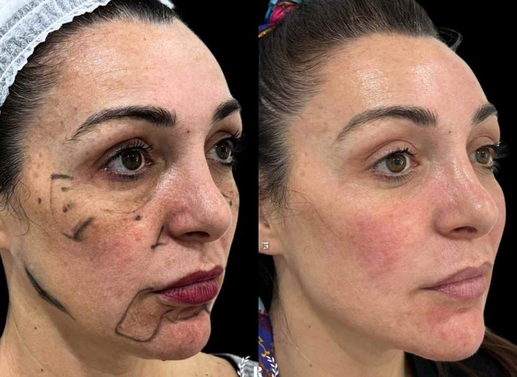 Imagen armonización facial antes y después con medicina estetica malaga en la mejor clinica estetica