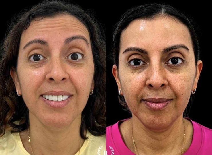 la mejor clinica estetica de malaga en reducción de lineas de expresión imagen paciente antes y después tratamiento neuromoduladores