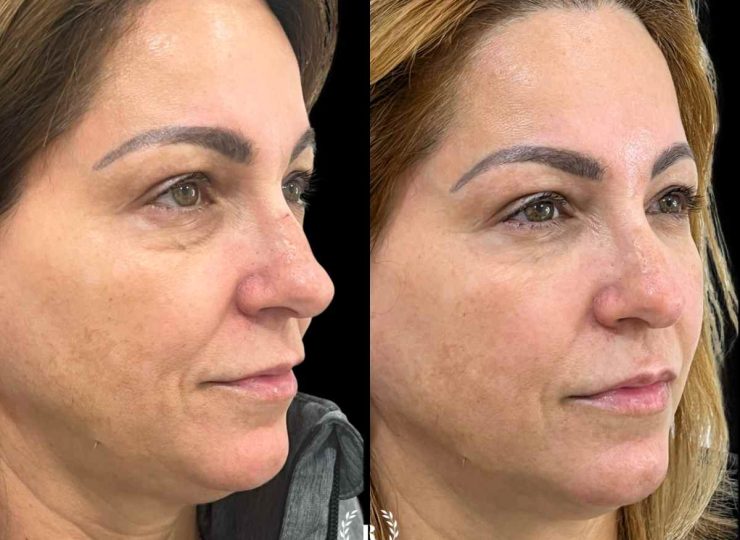 Imagen paciente procedimiento antes y después relleno de ojeras