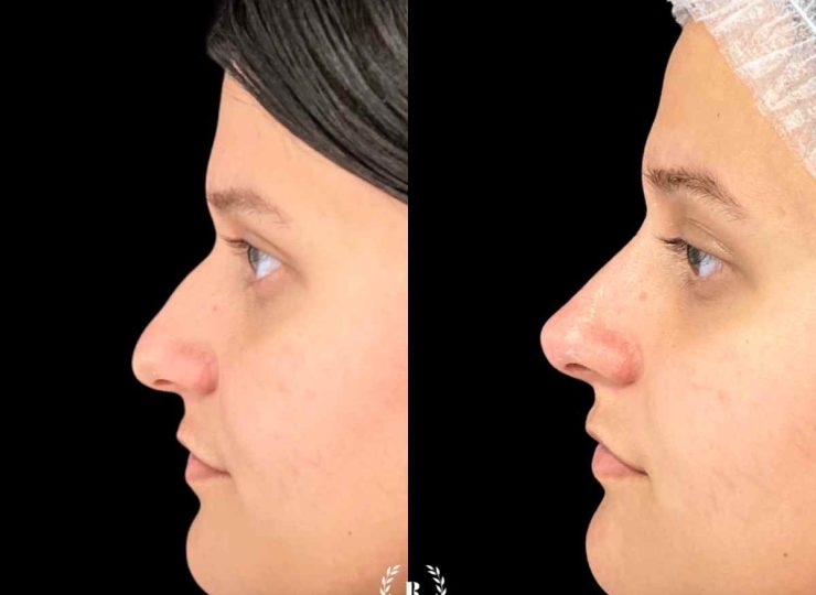 Rinomodelación antes y después en Clínica Roma, la mejor clinica estetica Malaga