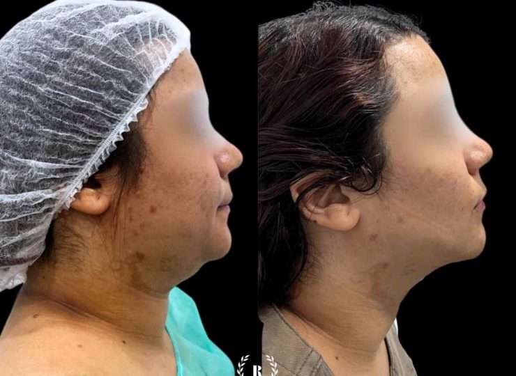 Imagen Tratamiento de papada antes y después con medicina estetica en malaga, la mejor clinica estetica malaga - Clinica Roma