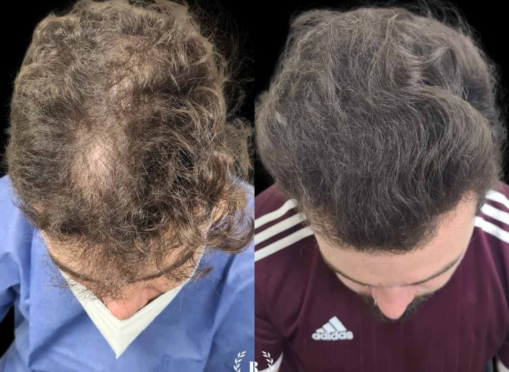 Antes y después de tratamiento capilar en Clinica Roma, la mejor clinica estetica Malaga