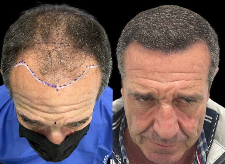 Imagen (4) antes y después transplante capilar