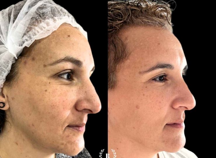 Tratamiento de manchas en la piel antes y después en Clinica Roma, la mejor clinica estetica Malaga