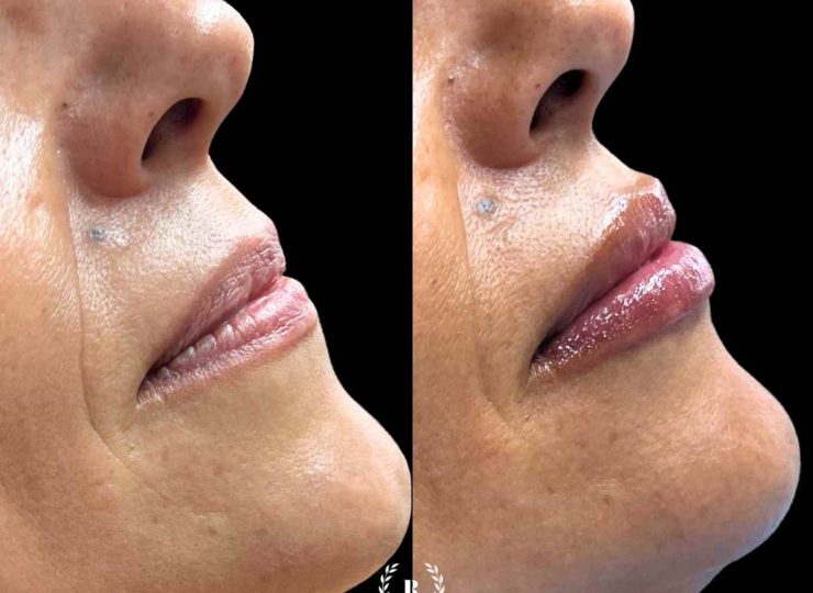 Imagen Tratamiento de labios antes y después con la mejor clinica estetica malaga