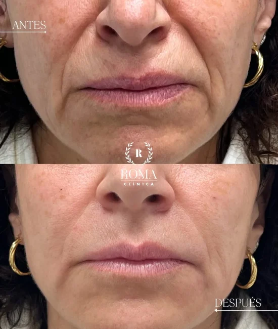 Surco nasogeniano en Clinica Roma